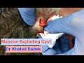 Massive Exploding Cyst plus Dr Khaled Sadek gets a hair cut!