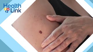 What to know about skin cancer risks: HealthLink