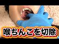 喉ちんこを1つ切除しました。
