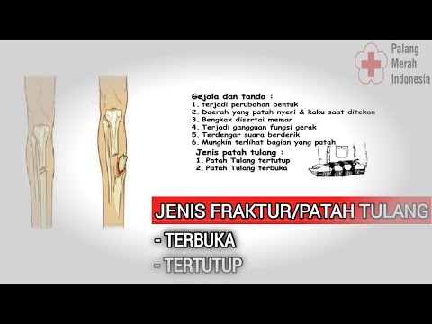 Video: Fraktur Kaki - Gejala, Bengkak Dan Rawatan Patah Kaki Terbuka Dan Tertutup. Bagaimana Mengembangkan Kaki?