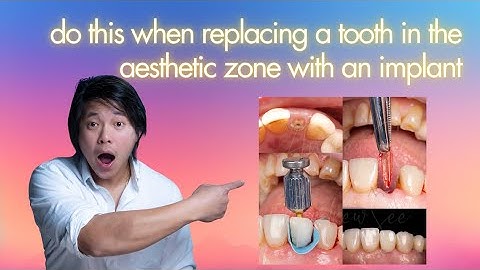 PET Socket Shield Technique STEP-BY-STEP Over The Shoulder