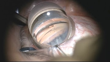 Bac Nguyen, MD: Kahook Dual Blade® (KDB) Utilizing Trypan Blue
