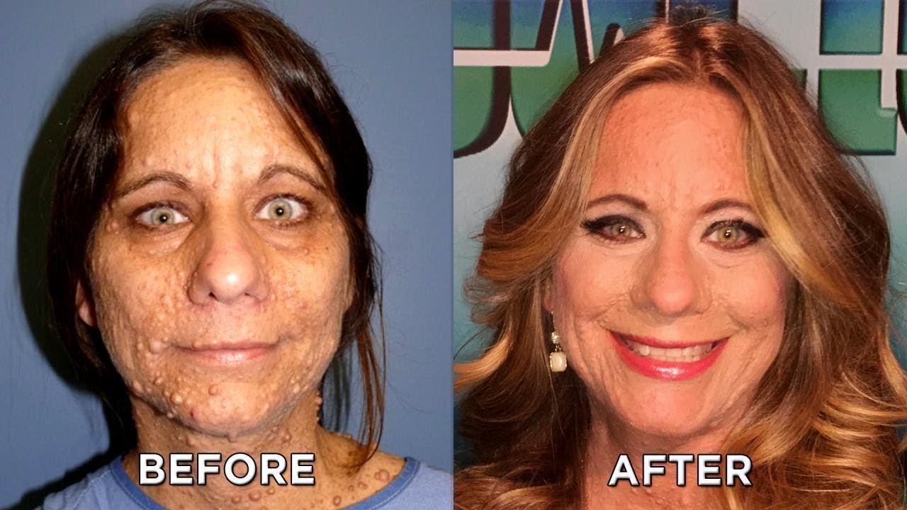 Check out Woman’s New Look after Tumor Removal Procedures YouTube
