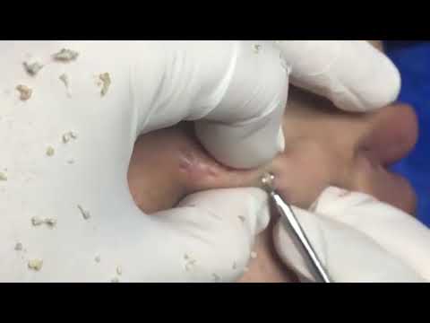 (AMAZING) !!! BEST BLACKHEAD REMOVE AND CYSTIC  REMOVE ON FACE (PART )