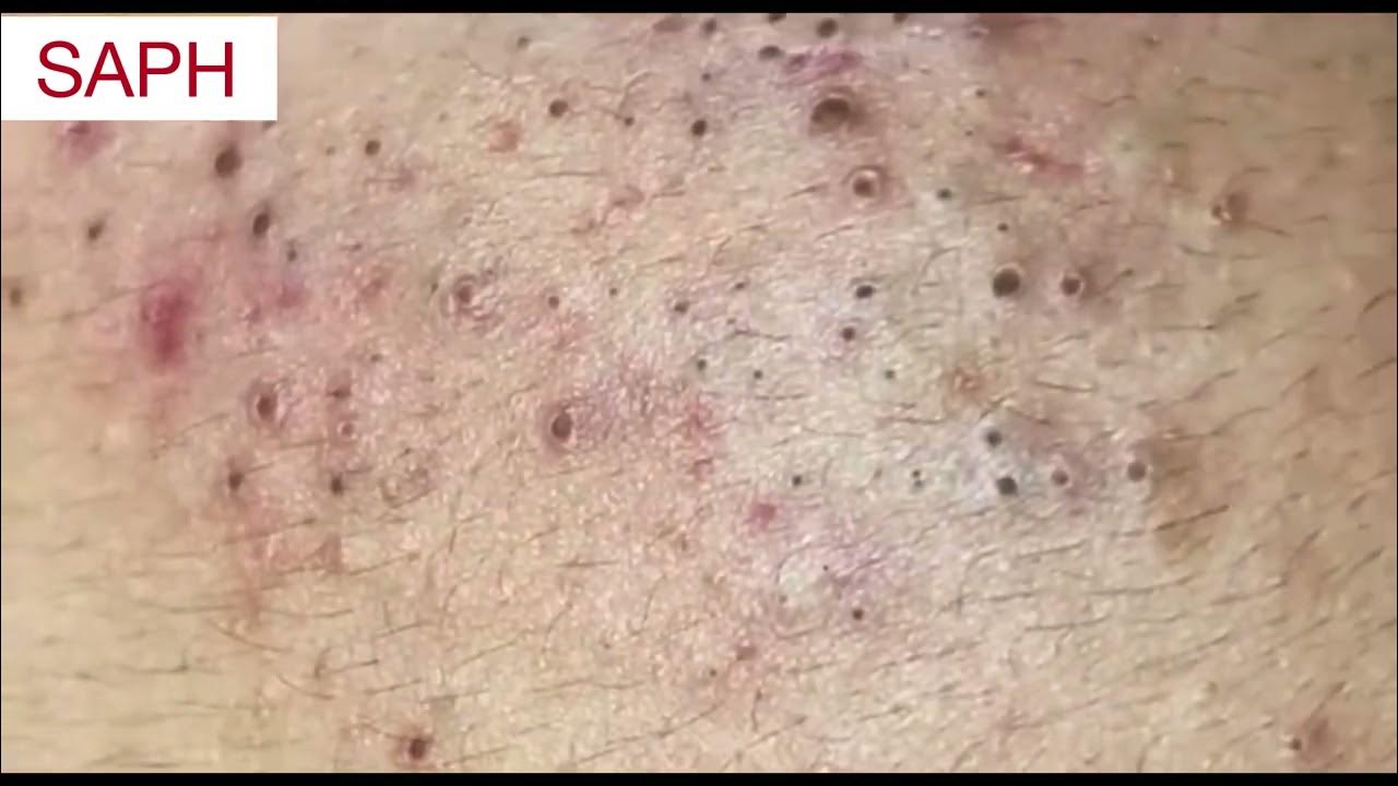 Say Goodbye to Big Blackheads The Ultimate Guide to Clear Skin! YouTube Say Goodbye to Big Blackheads The Ultimate Guide to Clear Skin! YouTube