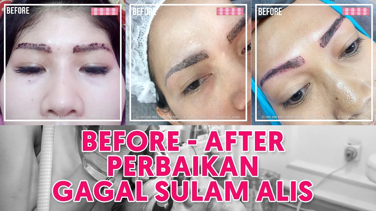 GAGAL SULAM  ALIS   Before After setelah perbaikan GAGAL 