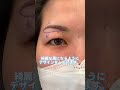 厚ぼったい瞼を解消‼️デザイン解説👩⚕️ #眉下リフト #眉下切開 #美容整形 #整形 #ダウンタイム