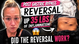 6 Wk Post Gastric Bypass Reversal Update