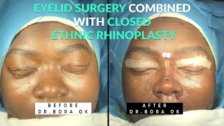 Upper Eyelid & Closed Ethnic Rhinoplasty Combined by Dr. Bora Ok in Istanbul!