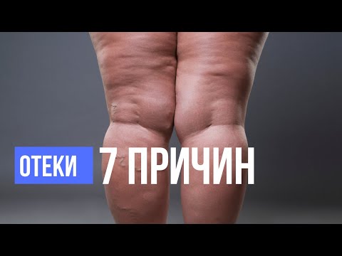 7 причин отеков. Как избавиться от отеков. Отечный синдром или лишний вес