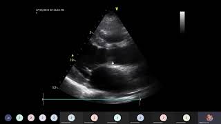 Infective endocarditis