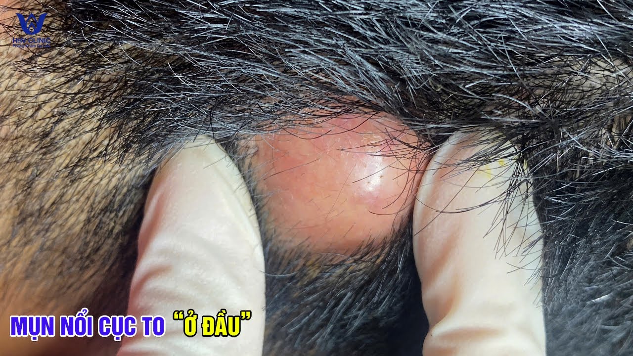 Mụn áp xe nang bã ở đầu sưng viêm, nặn nhiều dịch mủ.
