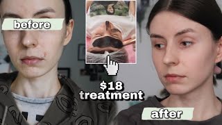 this $18 treatment helped my acne in 3 weeks