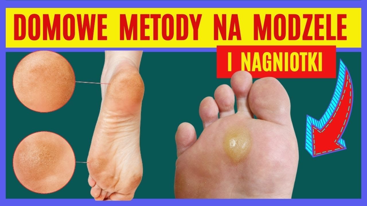 Od Czego Zależy Stopień Dysocjacji Modzele, Nagniotki, - Jak się ich pozbyć ze stóp ? Domowe sposoby na