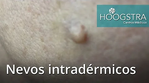 O que é um nevo Intradermico?