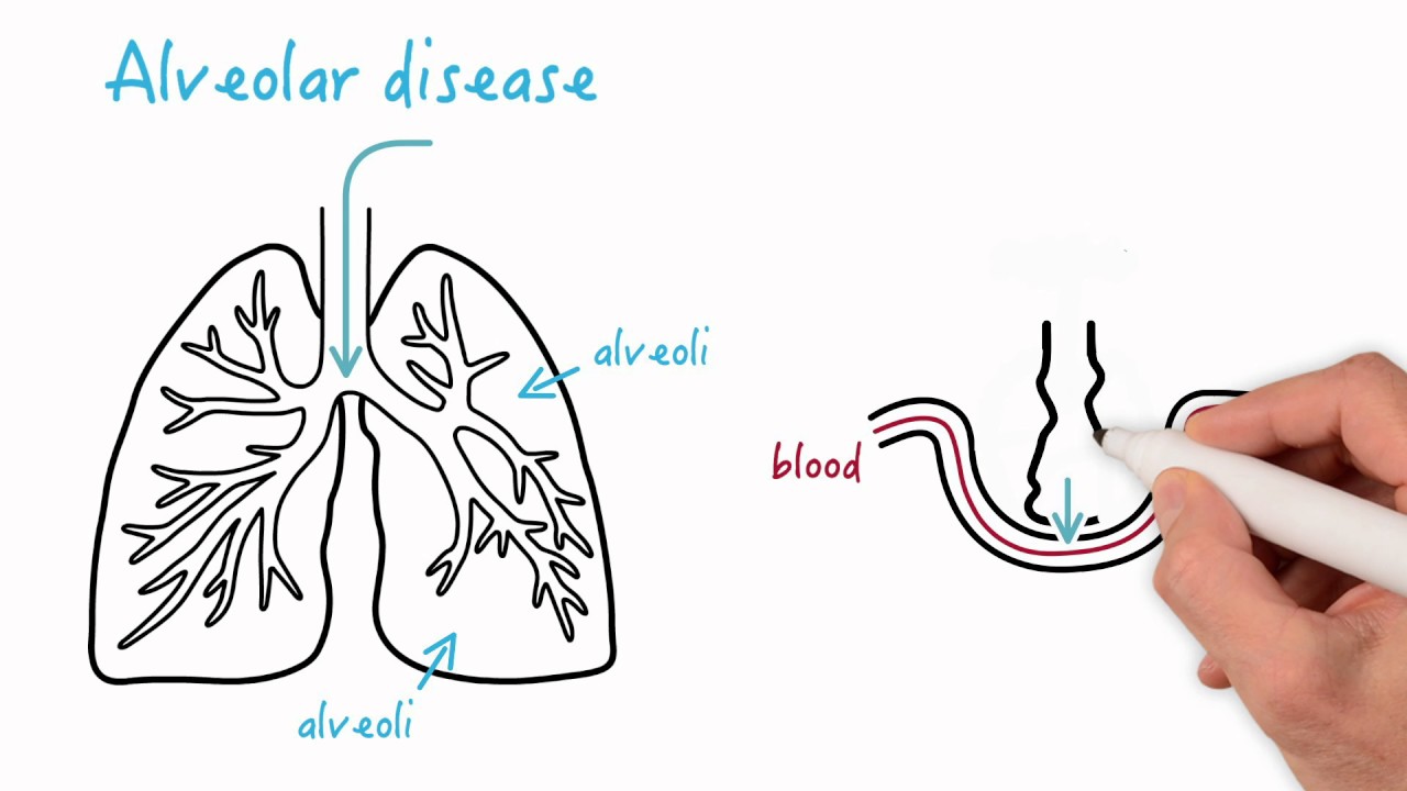 Airway disease versus alveolar disease