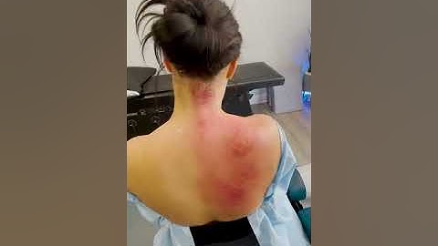 Graston Therapy By Dr. Tristan Smith