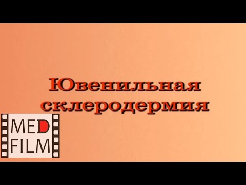 Видео: Что такое ювенильная склеродермия?