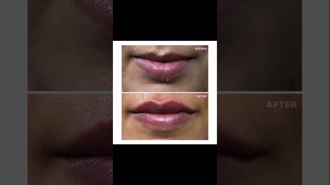 Lip Filler Transformation 💋 | Stunning Before & After Results | Dr Pragati Shubha 