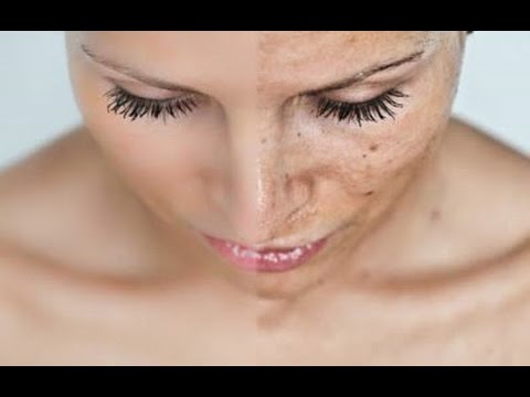 REMEDIOS PARA QUITAR LAS MANCHAS DE LA PIEL - Edad-  Quemaduras - Sol - Acne