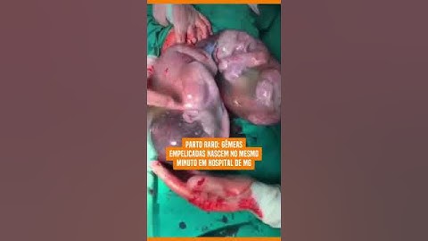 Parto raro: gêmeas empelicadas nascem no mesmo minuto em hospital de MG #uol #shorts