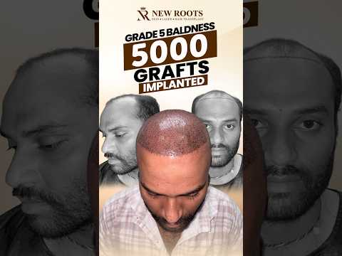5000 Grafts Hair Transplant in Raipur | Grade 5 Baldness Surgery #hair #viral #shorts