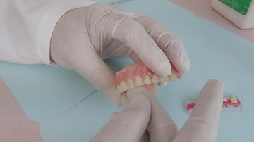 How to replace a tooth in a denture?