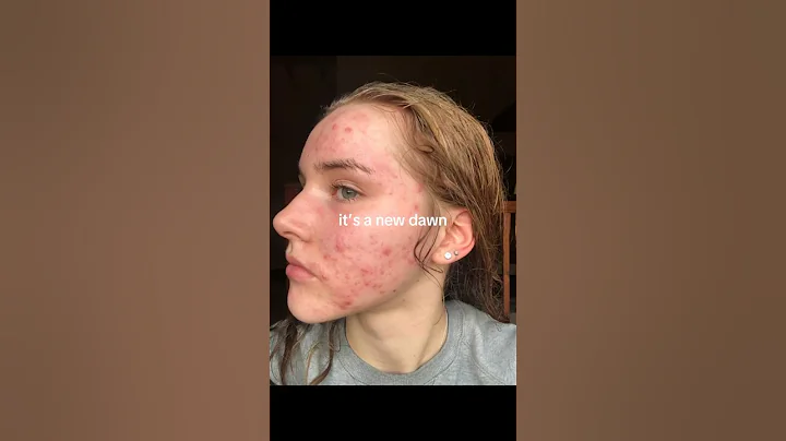 my acne journey #acne #acnejourney #shorts