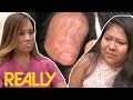 Daughters Bullied Over Mother’s Abnormal Cyst I Dr. Pimple Popper: This Is Zit!