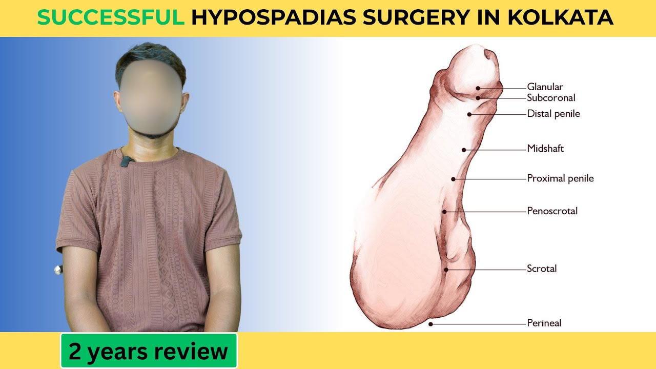 Successful hypospadias surgery in Kolkata|Hypospadias surgery result |2 years review | Cosmoaid