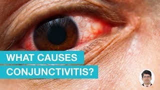 What Causes Conjunctivitis?