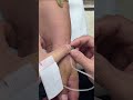 Intramuscular Injection Technique Explained | Safe IM Injection Step-by-Step | Nurse Guide Class 15