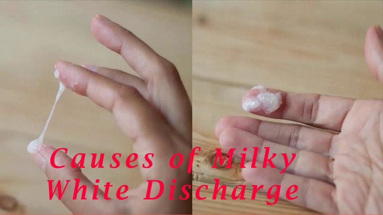 Milky White Discharge What Does It Mean Vaginal Discharge