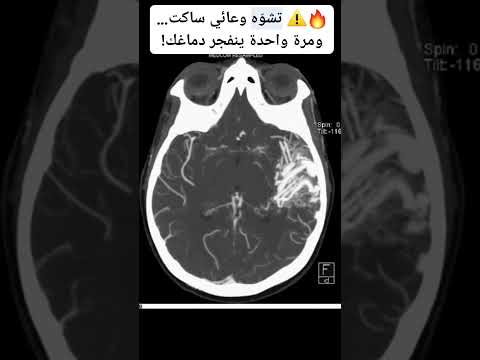 تشو ه وعائي ساكت ومرة واحدة ينفجر دماغك 