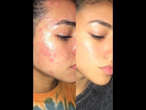 HOW I CLEARED MY ACNE BY FACE MAPPING (LEGIT)