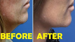 how to get rid of loose skin under chin and neck