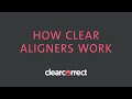 How clear aligners work