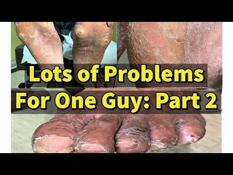 lots-of-problems-for-one-guy,-part-2:-painful-calluses-and-corn-between-the-toes