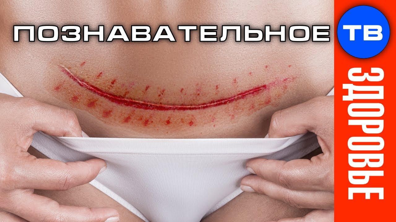 Что приводит к кесареву сечению? (Владимир Базарный) - YouTube