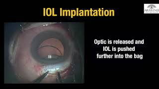 Rigid IOL implantation in MSICS