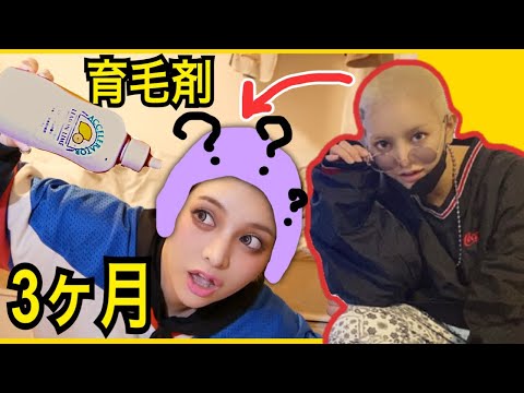 【検証】最強育毛剤で丸坊主から3ヶ月で〇〇cm伸びる!?【即効性】