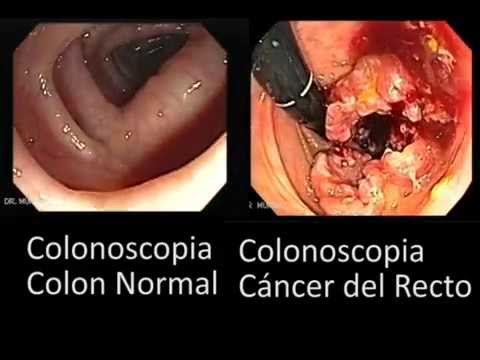 cancer de colon en la etapa 4)