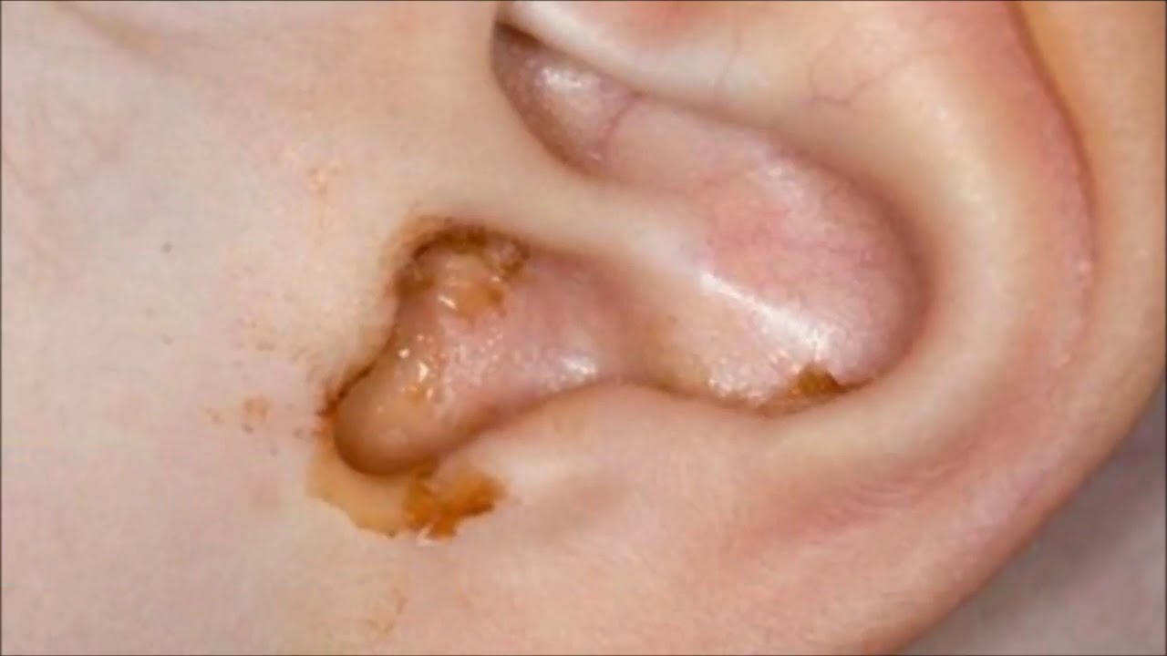 Best Way To Remove Ear Wax Put a Drop of Vinegar Alcohol Into Your Ear