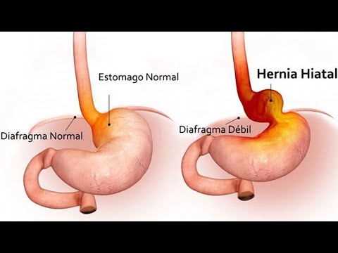 ¿Qué es y cómo se trata una hernia hiatal?