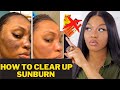 How to Get Rid of Sunburn on Face Hyperpigmentation | stop melasma and reverse it