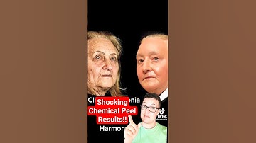SHOCKING CHEMICAL PEEL BEFORE AND AFTER - Phenol Peel #shorts