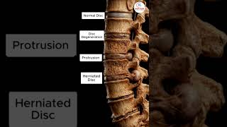 Slip Disc ऐसे धीरे-धीरे बढ़ती है… Spine का सच देखिए !