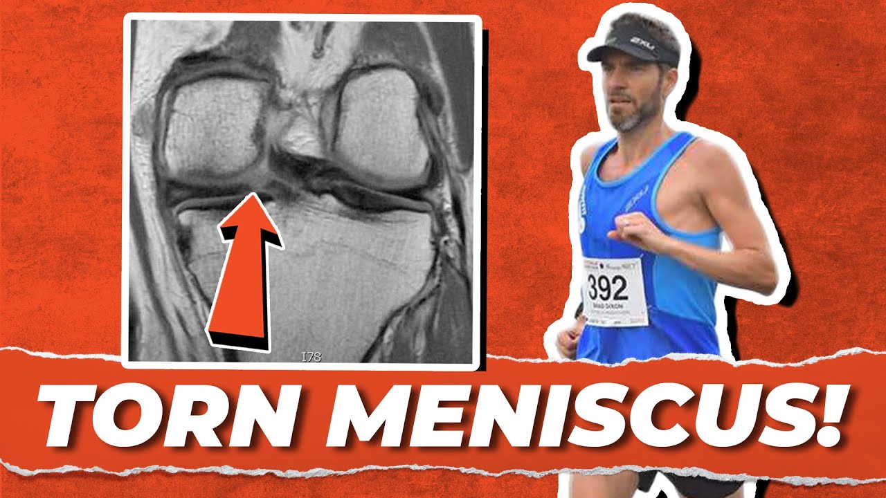 marathon training and meniscus tear)