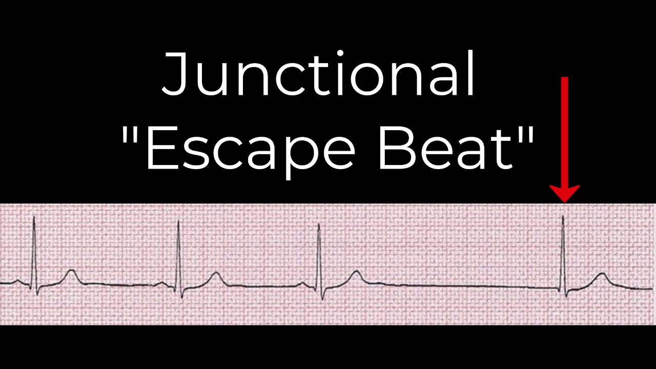 8 Junctional rhythms YouTube