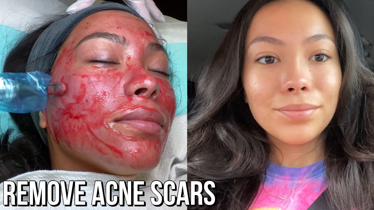 Microneedling Session #4 Results + Progress